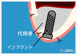 サイナスリフト