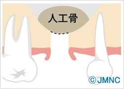 ソケットリフト
